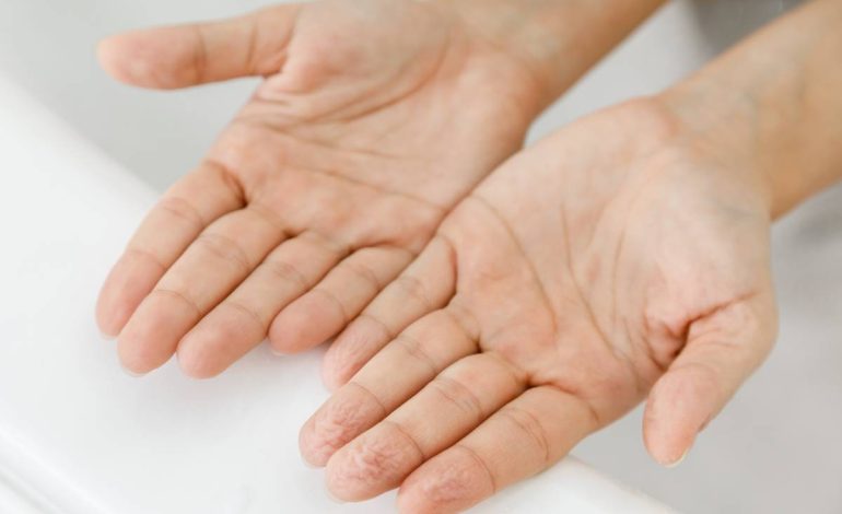 How to Address and Resolve Excessive Hand Sweating ?