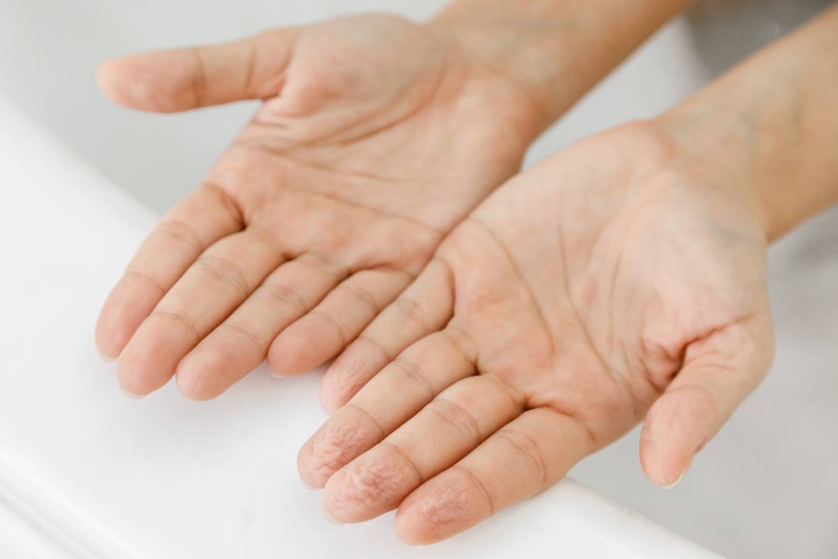 How to Address and Resolve Excessive Hand Sweating ?