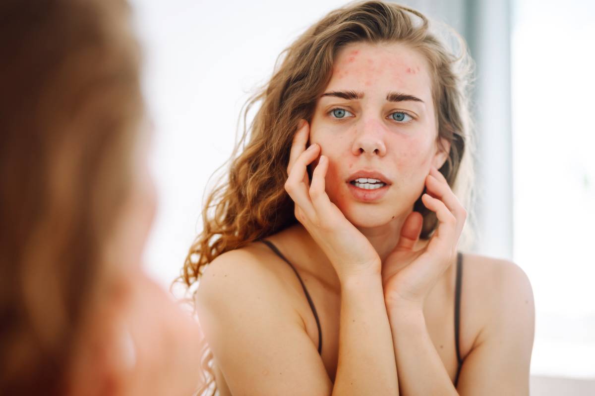 How do antihistamines relieve acne? Can they really help with acne?